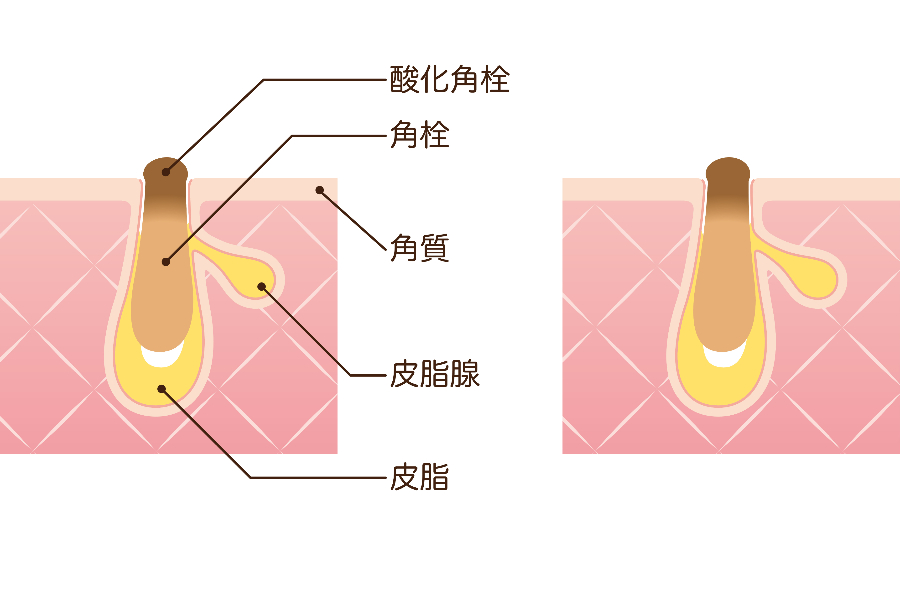 角栓が酸化すると黒くなります
